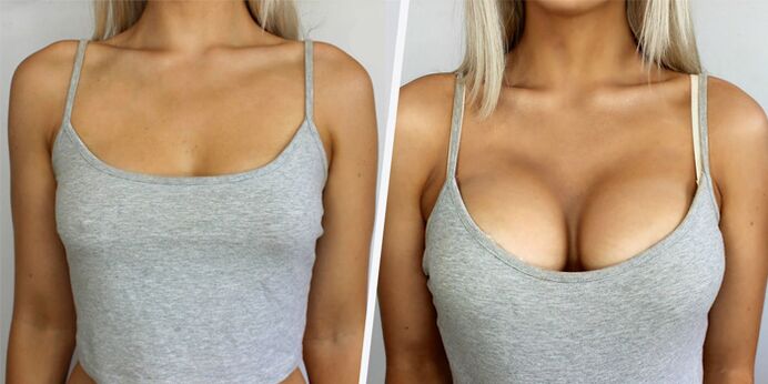 před a po plastické chirurgii pro zvětšení prsou