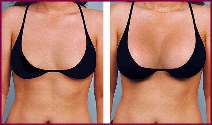 před a po zvětšení prsou tukem