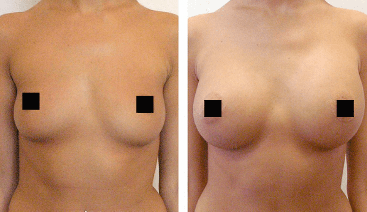 prsa před a po augmentaci kyselinou hyaluronovou