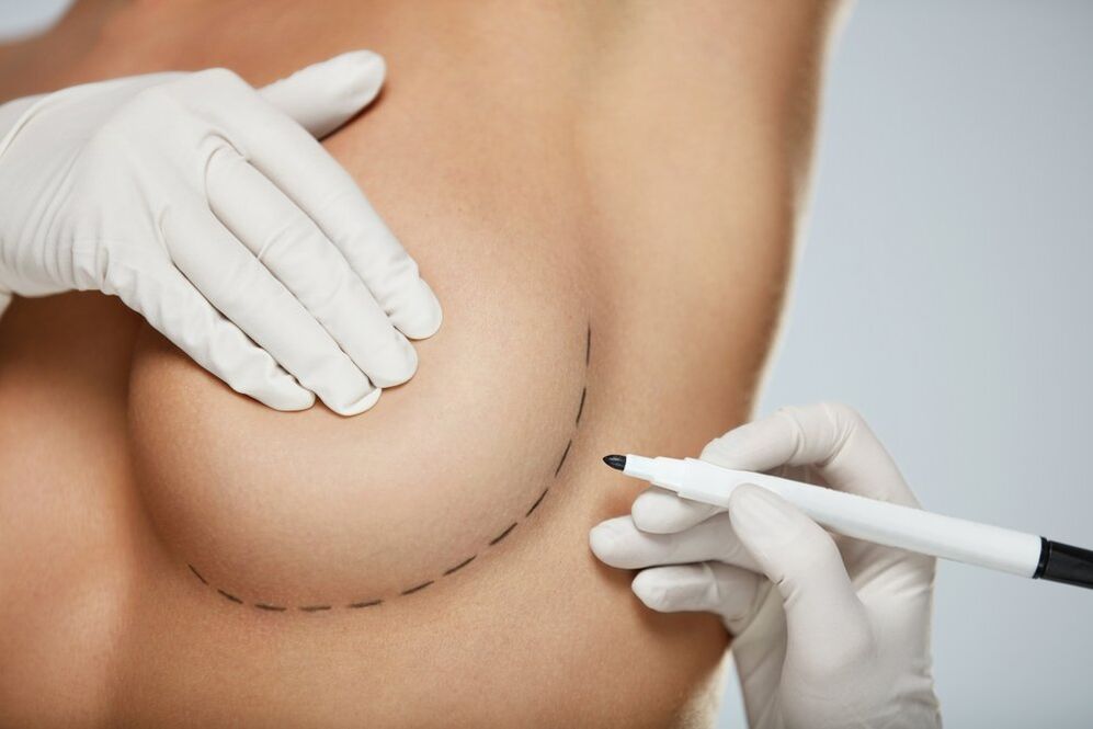 periareolární mamoplastika prsu
