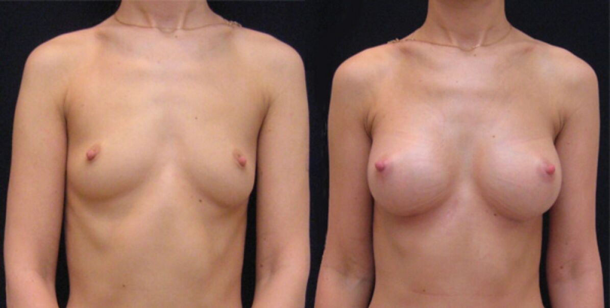 prsu před a po endoskopické augmentaci