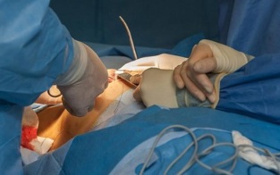 jak se provádí operace zvětšení prsou