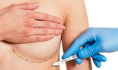 Submajrický přístup ke zvětšení prsu s implantáty