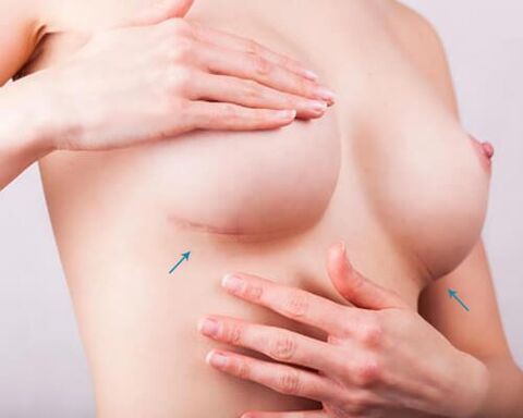 Zvětšení prsou s implantáty