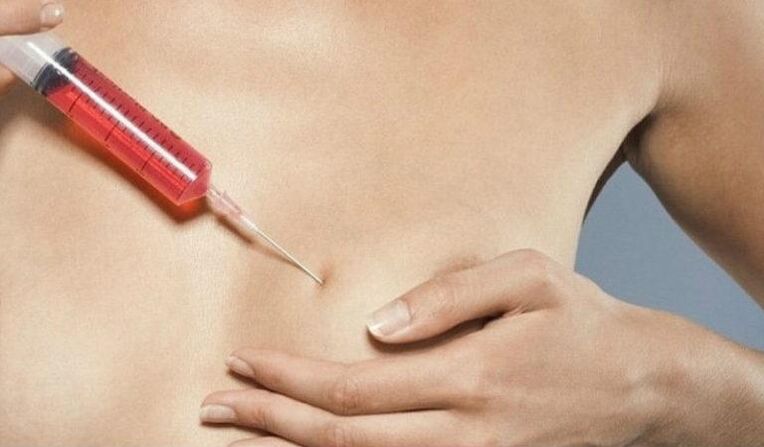 Zvětšení prsou injekcemi kyseliny hyaluronové