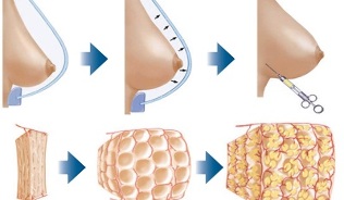 jak se provádí postup zvětšení prsou s tukem