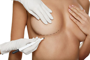 Značení značkou před operací zvětšení prsou